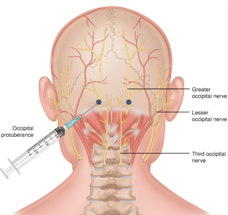 Greater Occipital Nerve block