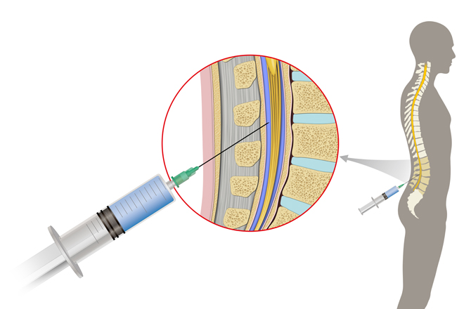 lumbar puncture 